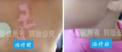 兒童頸部白癜風治好案例