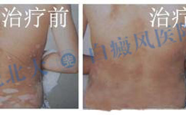 背部白癜風怎樣治療比較好 