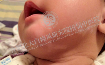  如何預防兒童白癜風的發生呢  
