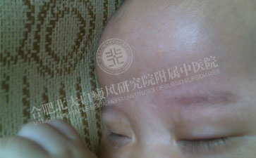 那么兒童白斑病怎么醫治更好 