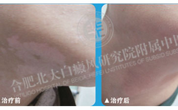 脖子長白斑到底該怎么辦 