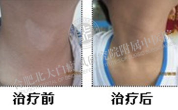 頸部白癜風治療需要注意什么呢 