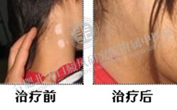  頸部白癜風究竟怎么處理才對  