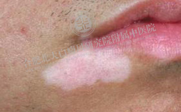面部白癜風如何護理比較好 