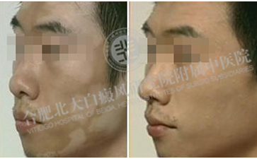 兩月治好面部白癜風，從此不再“臉上無