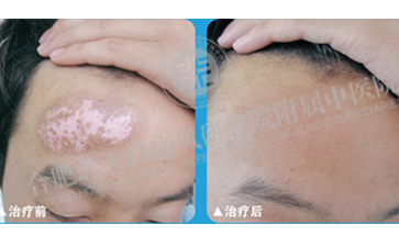男性患上白癜風到底怎么去對待 