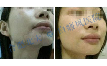  女性泛發(fā)性白癜風(fēng)的護(hù)理方法是什么呢  