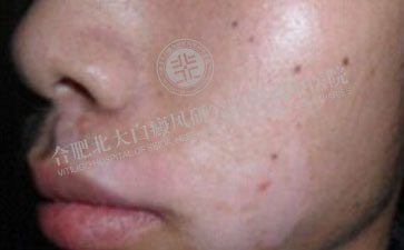 青少年白癜風(fēng)怎么治療好 