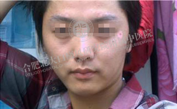  青少年白癜風(fēng)引發(fā)因素究竟是哪些方面  