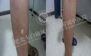  腿部患上白癜風(fēng)究竟是怎么樣發(fā)生呢  
