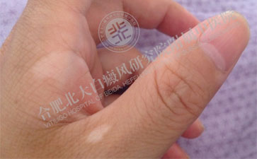  手上出現(xiàn)白癜風(fēng)究竟是怎么回事  