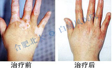 手部白癜風(fēng)要怎么護(hù)理效果好 