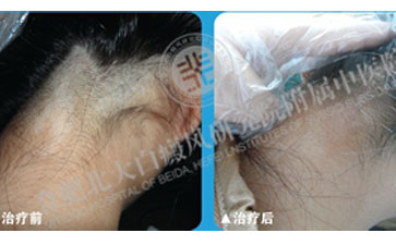 怎樣針對頭部白癜風做好治療 