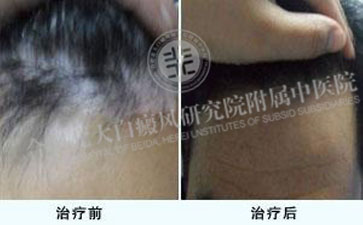 白癲風不治療會導致禿頭嗎 